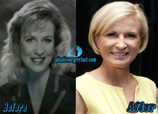 Has Mika Brzezinski had filler injections?