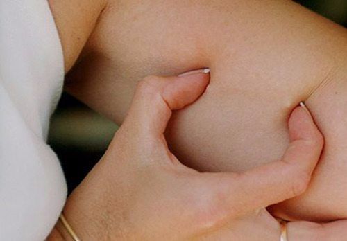 birth control implant